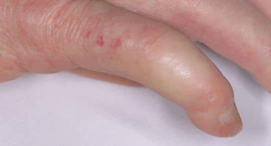 What Causes You To Have Swollen Fingers In The Morning Aging Healthy