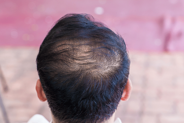 Tips To Treat Thinning Hair On Men